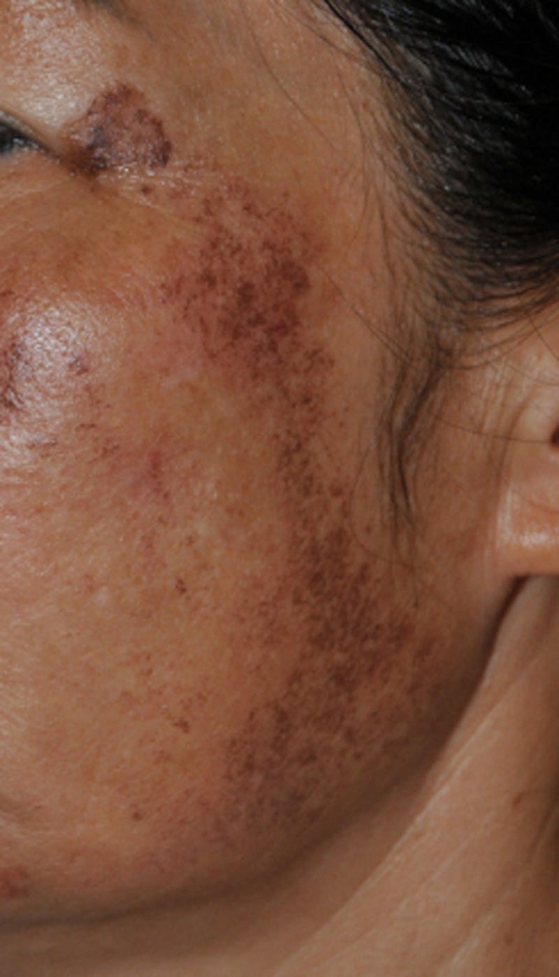 Intense Pulse Light Before & After Gallery - Patient 399573 - Image 7