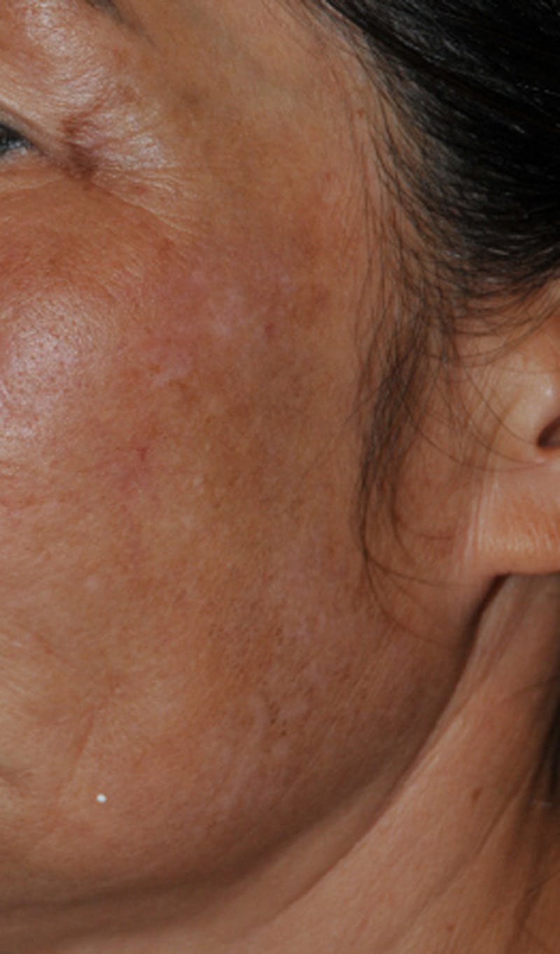 Intense Pulse Light Before & After Gallery - Patient 399573 - Image 8