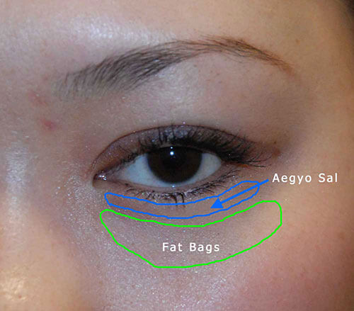 eyelid surgery diagram