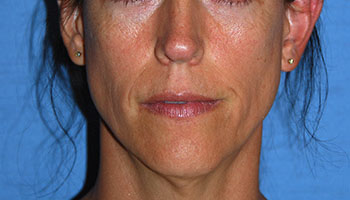 before Buffalo Gull lip procedure
