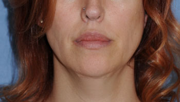 after Buffalo Gull lip procedure