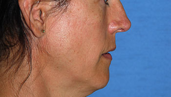 before Buffalo Gull lip procedure