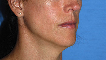 before Buffalo Gull lip procedure