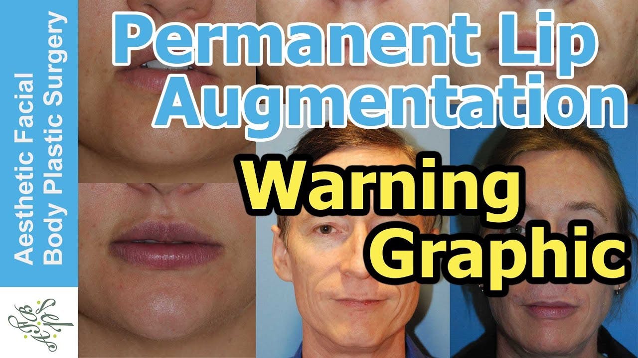 lip augmentation thumbnail