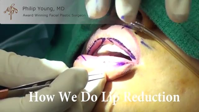 Lip Reduction thumbnail
