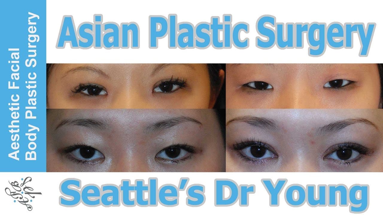 Asian Ethnic Rhinoplasty thumbnail