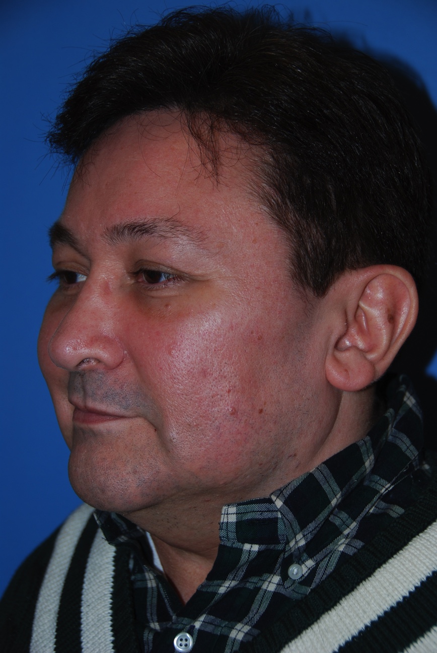 Patient facing Left Oblique View