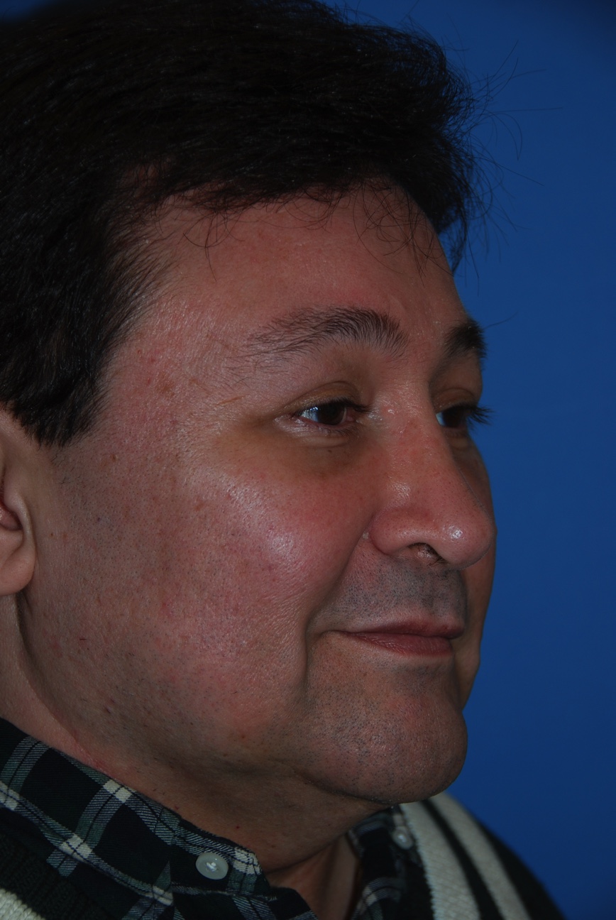 Patient facing Right Oblique View