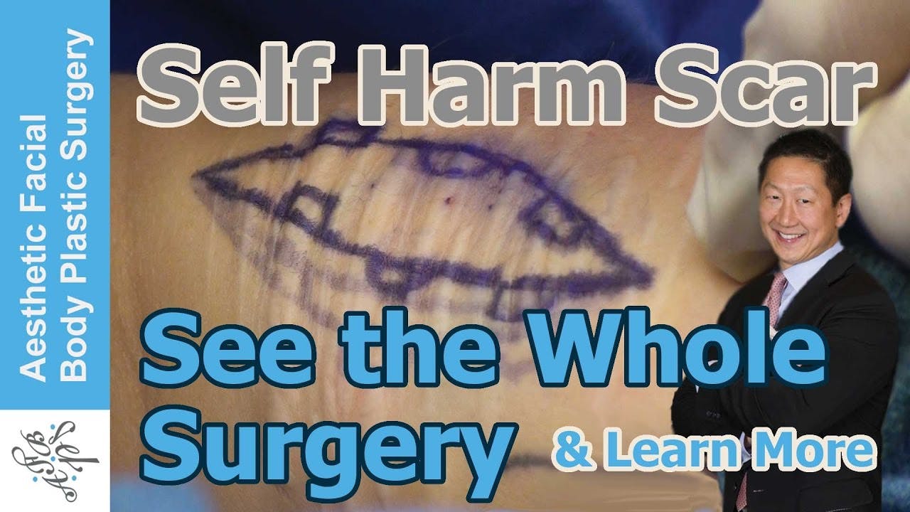 Scar video thumbnail