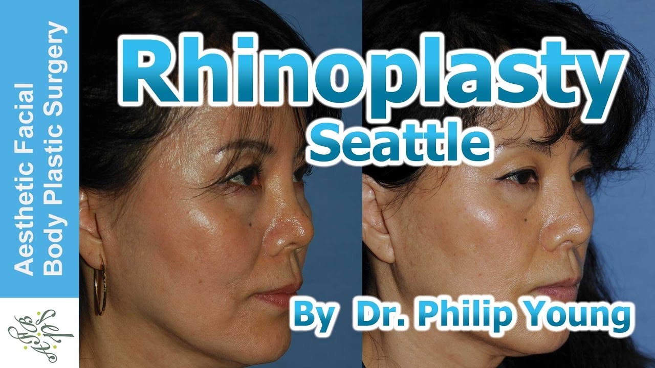 Rhinoplasty video thumbnail