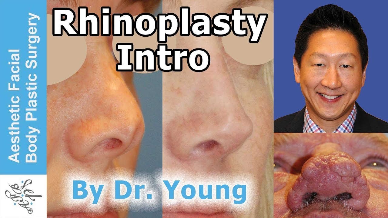 Rhinoplasty video thumbnail