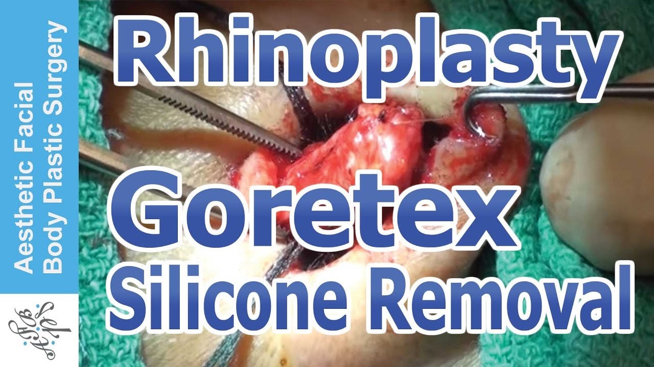 REVISION RHINOPLASTY video thumbnail