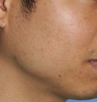 after Acne Medication