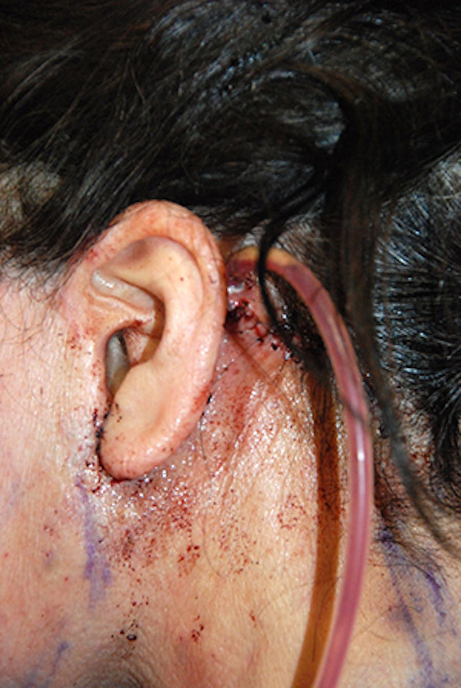 facelift tubes