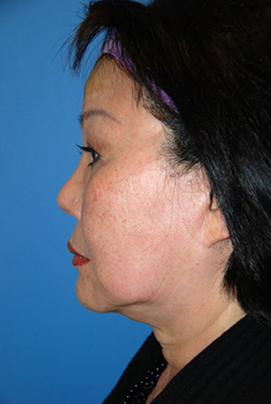 before image