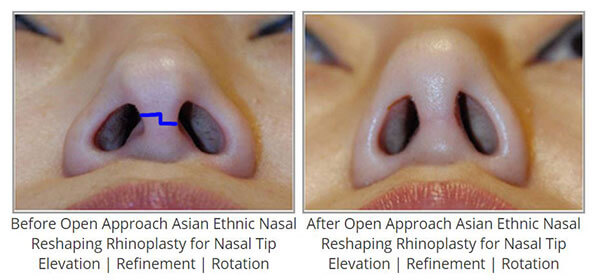 Open Rhinoplasty Approach