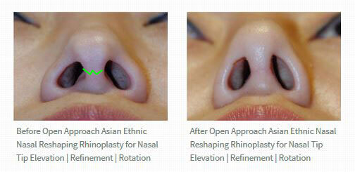Open Rhinoplasty Approach