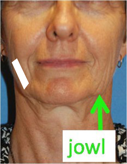 example of taping