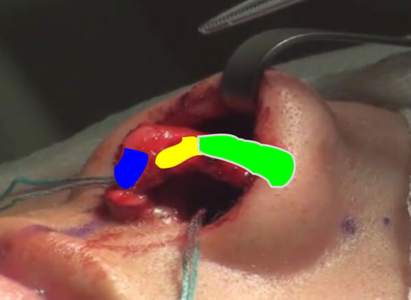 intraoperative view of the nose