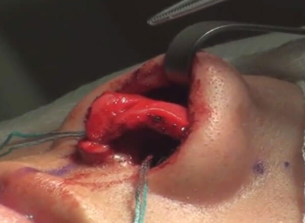 intraoperative view of the nose