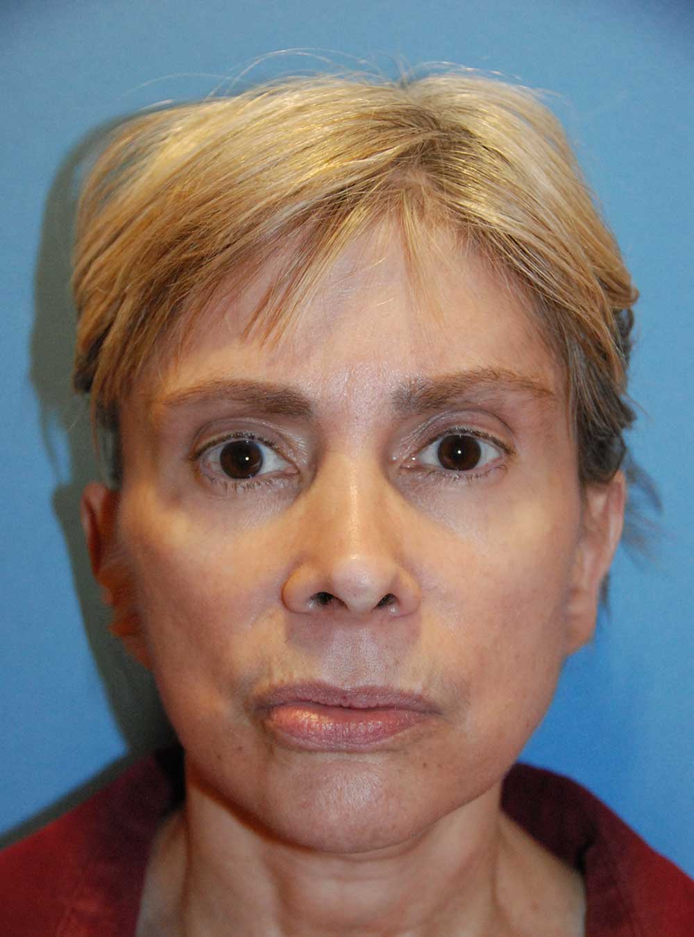 Otoplasty Revision before
