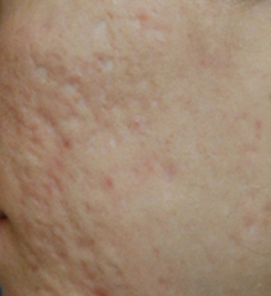 scar