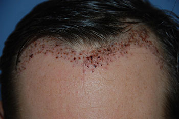 after hair transplant