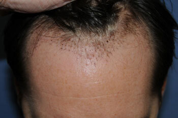 after hair transplant