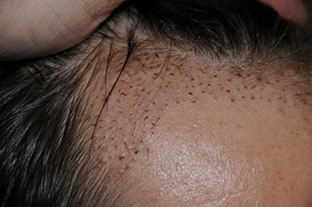after hair transplant