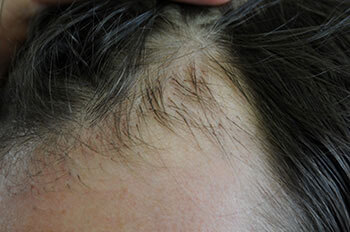 after hair transplant