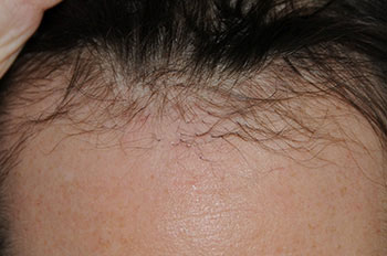 after hair transplant