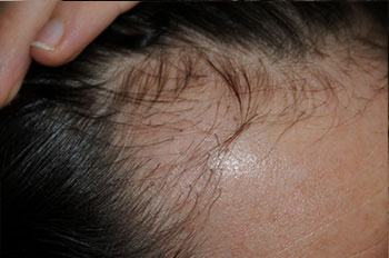 after hair transplant