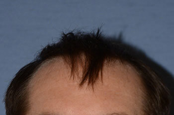 before hair transplant