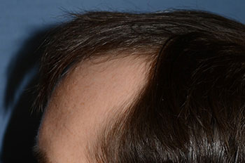 before hair transplant