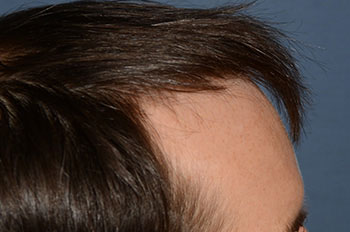 before hair transplant