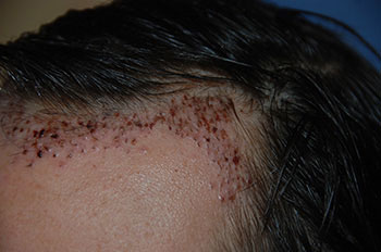 after hair transplant