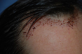 after hair transplant