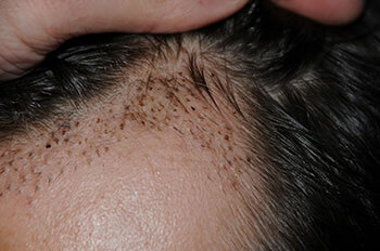 after hair transplant