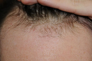 after hair transplant
