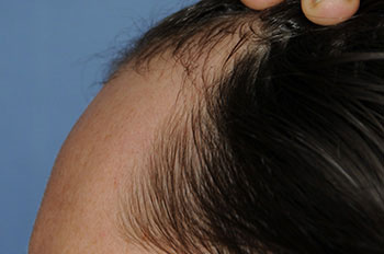 after hair transplant
