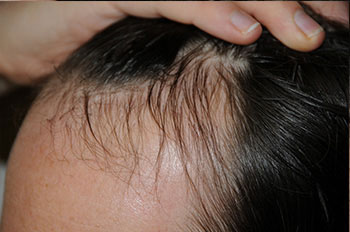 after hair transplant