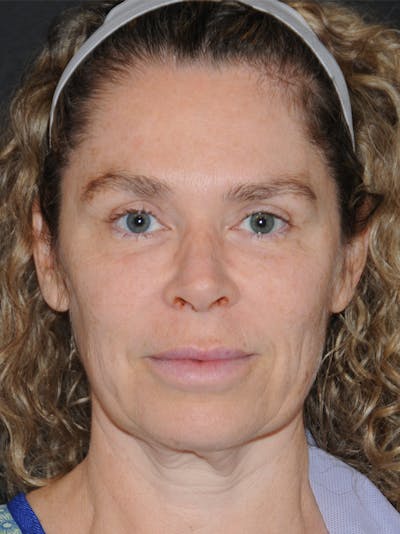 Facelift Before & After Gallery - Patient 370691 - Image 1