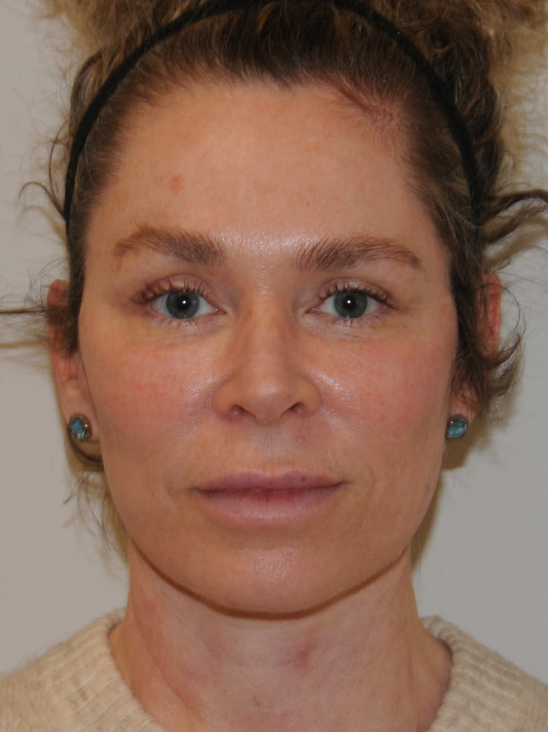 Facelift Before & After Gallery - Patient 370691 - Image 2