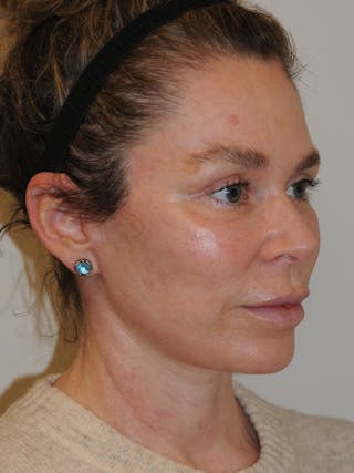 Facelift Before & After Gallery - Patient 370691 - Image 4
