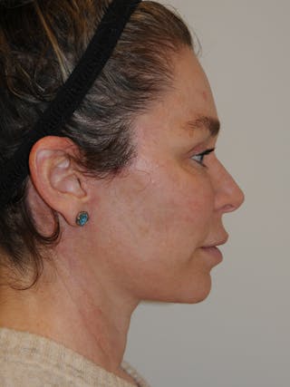 Facelift Before & After Gallery - Patient 370691 - Image 6
