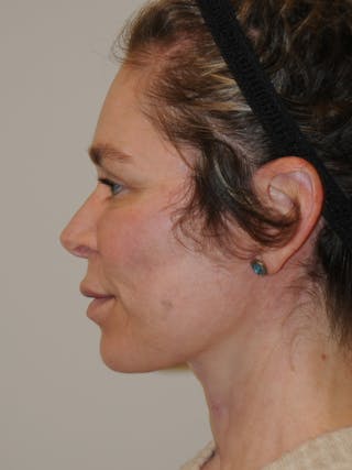 Facelift Before & After Gallery - Patient 370691 - Image 10