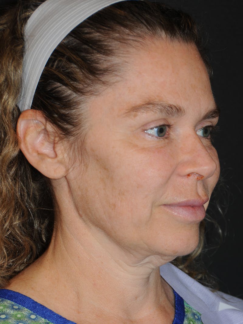 Facelift Before & After Gallery - Patient 370691 - Image 3