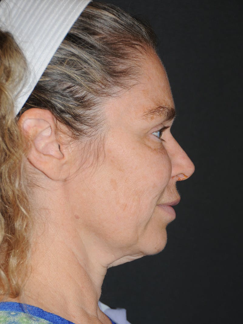 Facelift Before & After Gallery - Patient 370691 - Image 5