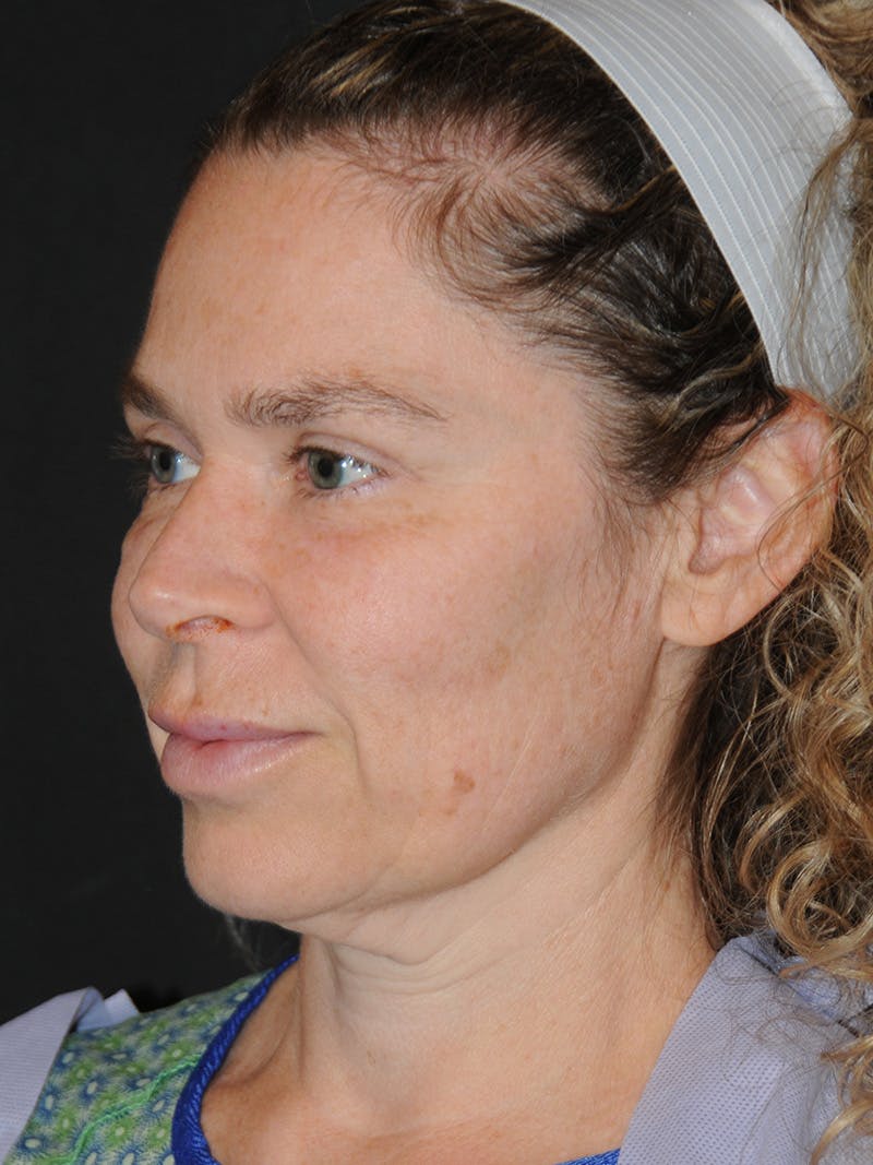 Facelift Before & After Gallery - Patient 370691 - Image 7