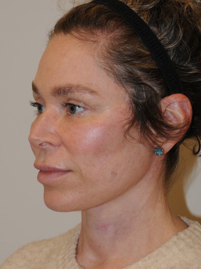 Facelift Before & After Gallery - Patient 370691 - Image 8